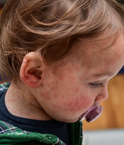 Child with measles